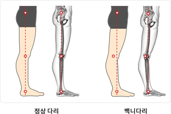 AI 자세분석 알고리즘으로 O다리와 X다리, 백니 상태를 비교 분석한 이미지
